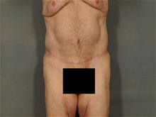 Tummy Tuck After Photo by Ellen Janetzke, MD; Bloomfield Hills, MI - Case 29421