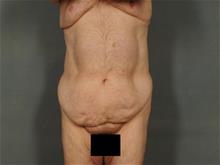 Tummy Tuck Before Photo by Ellen Janetzke, MD; Bloomfield Hills, MI - Case 29421