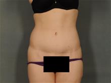 Tummy Tuck After Photo by Ellen Janetzke, MD; Bloomfield Hills, MI - Case 29422