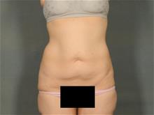 Tummy Tuck Before Photo by Ellen Janetzke, MD; Bloomfield Hills, MI - Case 29422
