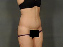 Tummy Tuck After Photo by Ellen Janetzke, MD; Bloomfield Hills, MI - Case 29422
