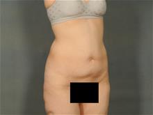 Tummy Tuck Before Photo by Ellen Janetzke, MD; Bloomfield Hills, MI - Case 29422