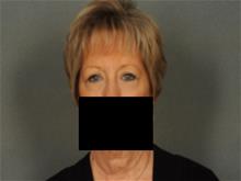 Eyelid Surgery After Photo by Ellen Janetzke, MD; Bloomfield Hills, MI - Case 29471