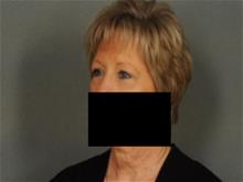 Eyelid Surgery After Photo by Ellen Janetzke, MD; Bloomfield Hills, MI - Case 29471