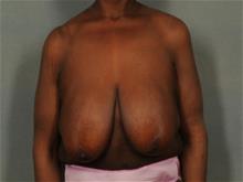 Breast Reduction Before Photo by Ellen Janetzke, MD; Bloomfield Hills, MI - Case 29472