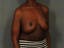 Breast Reduction After Photo by Ellen Janetzke, MD; Bloomfield Hills, MI - Case 29472