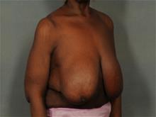 Breast Reduction Before Photo by Ellen Janetzke, MD; Bloomfield Hills, MI - Case 29472