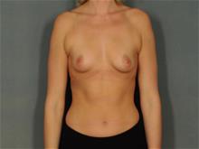 Breast Augmentation Before Photo by Ellen Janetzke, MD; Bloomfield Hills, MI - Case 29473
