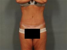 Tummy Tuck After Photo by Ellen Janetzke, MD; Bloomfield Hills, MI - Case 29474