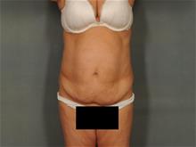 Tummy Tuck Before Photo by Ellen Janetzke, MD; Bloomfield Hills, MI - Case 29474