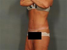 Tummy Tuck After Photo by Ellen Janetzke, MD; Bloomfield Hills, MI - Case 29474