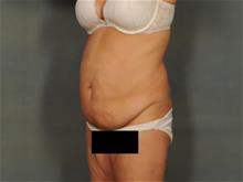 Tummy Tuck Before Photo by Ellen Janetzke, MD; Bloomfield Hills, MI - Case 29474