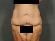 Tummy Tuck Before Photo by Ellen Janetzke, MD; Bloomfield Hills, MI - Case 29475