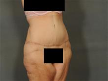 Tummy Tuck After Photo by Ellen Janetzke, MD; Bloomfield Hills, MI - Case 29475