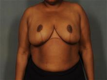 Breast Reduction After Photo by Ellen Janetzke, MD; Bloomfield Hills, MI - Case 29561