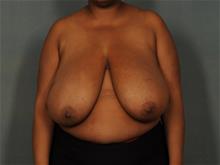 Breast Reduction Before Photo by Ellen Janetzke, MD; Bloomfield Hills, MI - Case 29561
