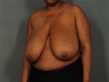 Breast Reduction Before Photo by Ellen Janetzke, MD; Bloomfield Hills, MI - Case 29561