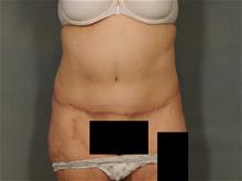 Tummy Tuck After Photo by Ellen Janetzke, MD; Bloomfield Hills, MI - Case 29562