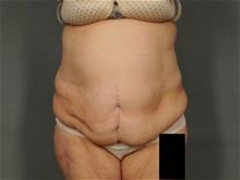 Tummy Tuck Before Photo by Ellen Janetzke, MD; Bloomfield Hills, MI - Case 29562
