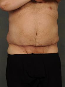 Tummy Tuck After Photo by Ellen Janetzke, MD; Bloomfield Hills, MI - Case 29565