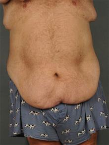 Tummy Tuck Before Photo by Ellen Janetzke, MD; Bloomfield Hills, MI - Case 29565