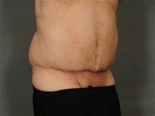Tummy Tuck After Photo by Ellen Janetzke, MD; Bloomfield Hills, MI - Case 29565
