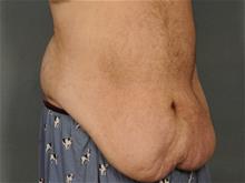 Tummy Tuck Before Photo by Ellen Janetzke, MD; Bloomfield Hills, MI - Case 29565