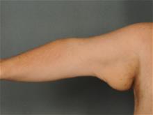 Arm Lift Before Photo by Ellen Janetzke, MD; Bloomfield Hills, MI - Case 29566