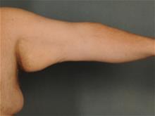 Arm Lift Before Photo by Ellen Janetzke, MD; Bloomfield Hills, MI - Case 29566