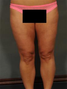 Liposuction After Photo by Ellen Janetzke, MD; Bloomfield Hills, MI - Case 29567