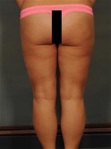 Liposuction After Photo by Ellen Janetzke, MD; Bloomfield Hills, MI - Case 29567