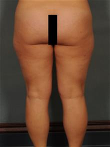 Liposuction Before Photo by Ellen Janetzke, MD; Bloomfield Hills, MI - Case 29567