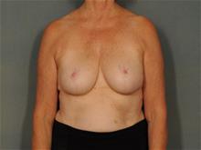 Breast Reduction After Photo by Ellen Janetzke, MD; Bloomfield Hills, MI - Case 29568