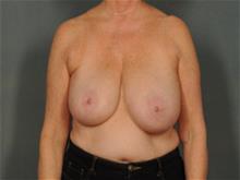 Breast Reduction Before Photo by Ellen Janetzke, MD; Bloomfield Hills, MI - Case 29568