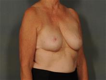 Breast Reduction After Photo by Ellen Janetzke, MD; Bloomfield Hills, MI - Case 29568