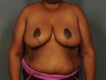 Breast Reduction After Photo by Ellen Janetzke, MD; Bloomfield Hills, MI - Case 29630
