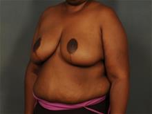 Breast Reduction After Photo by Ellen Janetzke, MD; Bloomfield Hills, MI - Case 29630
