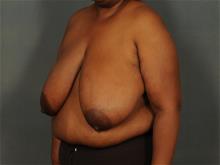 Breast Reduction Before Photo by Ellen Janetzke, MD; Bloomfield Hills, MI - Case 29630