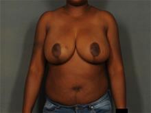 Breast Reduction After Photo by Ellen Janetzke, MD; Bloomfield Hills, MI - Case 29634