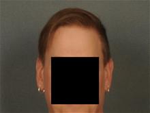Hair Transplant After Photo by Ellen Janetzke, MD; Bloomfield Hills, MI - Case 29722