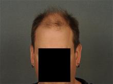 Hair Transplant Before Photo by Ellen Janetzke, MD; Bloomfield Hills, MI - Case 29722