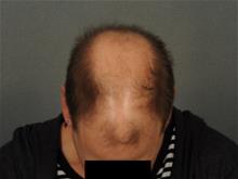 Hair Transplant Before Photo by Ellen Janetzke, MD; Bloomfield Hills, MI - Case 29722