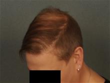 Hair Transplant After Photo by Ellen Janetzke, MD; Bloomfield Hills, MI - Case 29723