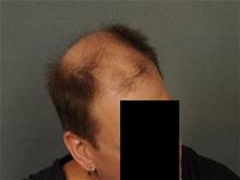Hair Transplant Before Photo by Ellen Janetzke, MD; Bloomfield Hills, MI - Case 29723