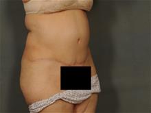 Tummy Tuck After Photo by Ellen Janetzke, MD; Bloomfield Hills, MI - Case 29724