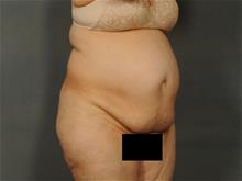 Tummy Tuck Before Photo by Ellen Janetzke, MD; Bloomfield Hills, MI - Case 29724