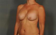 Breast Augmentation After Photo by Ellen Janetzke, MD; Bloomfield Hills, MI - Case 29744