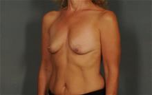Breast Augmentation Before Photo by Ellen Janetzke, MD; Bloomfield Hills, MI - Case 29744
