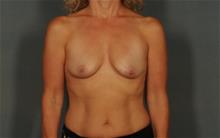 Breast Augmentation Before Photo by Ellen Janetzke, MD; Bloomfield Hills, MI - Case 29744