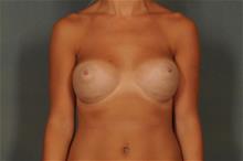 Breast Augmentation After Photo by Ellen Janetzke, MD; Bloomfield Hills, MI - Case 29763